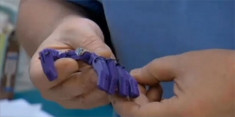 Ngón tay giả cho bé gái từ công nghệ in 3D