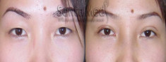 Bấm mí Hàn Quốc có ảnh hưởng đến thị lực của mắt?