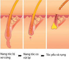 Bệnh rụng tóc và cách điều trị