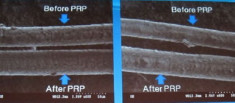Chữa bệnh rụng tóc bằng công nghệ sinh học PRP