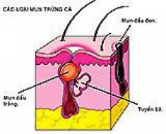 Điều trị và phòng ngừa mụn trứng cá