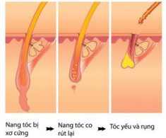 Giải pháp cho hiện tượng rụng tóc