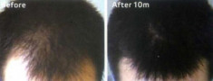 Hết rụng tóc, hói đầu sau 3 tháng