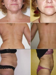 Hút mỡ bằng Laser Pharaon Lipo