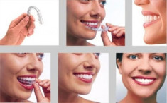 Invisalign - chỉnh nha với loạt khay trong suốt