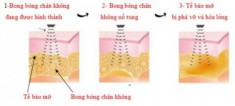 Loại bỏ ngấn mỡ nọng cằm không cần phẫu thuật