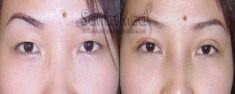 Phẫu thuật bấm mí Hàn Quốc có làm cho mắt đẹp hơn?