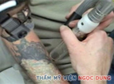 Tác dụng của laser trong việc xóa xăm