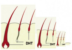 Tái tạo tóc bằng DHT và Testosteron