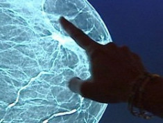 Tầm soát ung thư vú ‘hại nhiều hơn lợi’