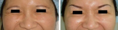 Trẻ hóa gương mặt bằng Botox và Restylane