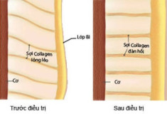 Trẻ hóa làn da nhờ sóng tạo năng lượng