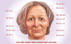 Trẻ lại nhờ Botox và Restylane