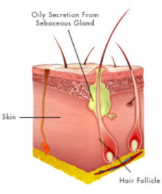 Trị mụn triệt để với công nghệ Laser Spectra Peel