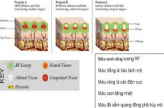 Xóa nhăn và sẹo bằng công nghệ Matrix-RF