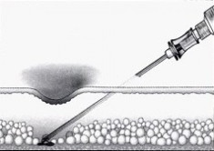 Xóa sẹo lõm, làm đầy da vùng thân bằng MacrolaneTM