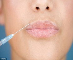 Biến dạng môi vì tiêm botox