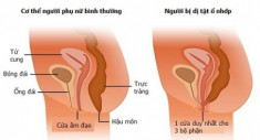 Xuất hiện người phụ nữ mang thai dù chỉ quan hệ bằng “cửa sau”