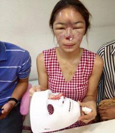 Cô gái suýt phải cắt bỏ mũi vì phẫu thuật thẩm mỹ hỏng