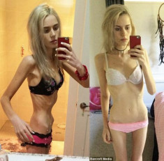 Cô gái 19 tuổi suýt chết vì nhịn ăn giảm cân