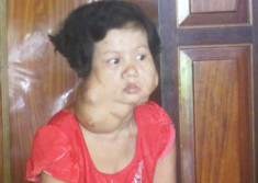  Người phụ nữ 43 năm mang khối u quái trên mặt 