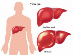  Viêm gan virus dễ dẫn đến xơ gan, ung thư gan 