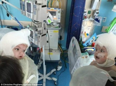 Hai bé trai song sinh liền đầu lần đầu được nhìn thấy nhau sau phẫu thuật