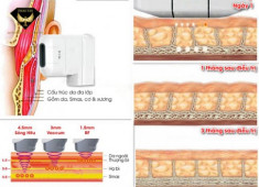 Nâng cơ căng da Hifu Smas Thera an toàn không phẫu thuật.