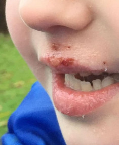 Người mẹ không ngờ vật dụng quen thuộc này khiến con 6 tuổi bị bỏng rộp, chảy máu môi