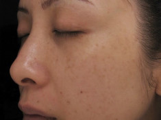 Beauty Skin– Giải pháp ‘đánh bay’ nám da, tàn nhang hiệu quả