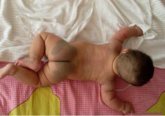 Lý giải sự thật đằng sau vết bớt xanh thường thấy trên mông trẻ sơ sinh