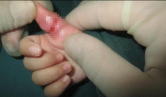 Mẹ trẻ hối hận vì thói quen thả tóc khiến con gái 5 tháng suýt phải cắt bỏ ngón tay