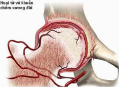 Hoại tử chỏm xương đùi: Căn bệnh đang trẻ hóa và gặp 80% ở nam giới