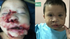 Phẫu thuật tạo hình thành công cho bé trai 2 tuổi bị chó cắn nát mặt