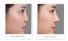 Nâng mũi bị tím mắt nguyên nhân vì đâu?