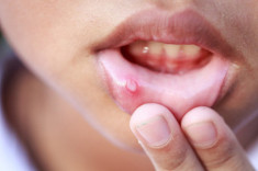 Những triệu chứng dễ nhầm lẫn về bệnh ung thư miệng thường gặp
