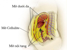 Cận cảnh một ca hút mỡ bụng khiến người phụ nữ cứng rắn nhất cũng phải… bật khóc!