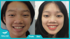 Sở hữu hàm răng bền đẹp với giá ưu đãi nhất từ trước đến nay tại Nha khoa Smile One