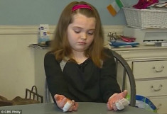 Cảnh báo: Bé gái 11 tuổi bị bỏng nặng ở tay do tiếp xúc với... hàn the