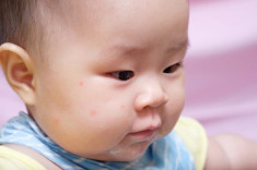 Trẻ sơ sinh bị nổi mẩn đỏ nên điều trị như thế nào?