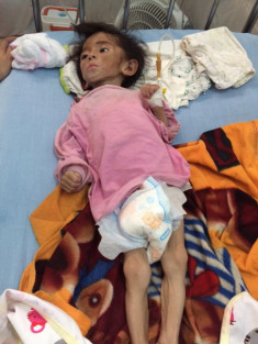 Hình ảnh mới nhất của bé gái Lào Cai bị suy dinh dưỡng: Cằm nhọn, cao lớn không nhận ra
