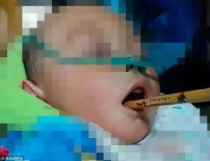 Mẹ bưng bát chạy theo đút cơm, bé trai 2 tuổi gặp nạn với chiếc đũa
