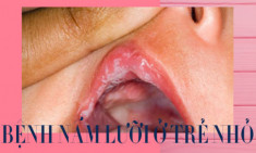Trẻ bị nấm lưỡi: Các phương pháp điều trị hiệu quả và an toàn