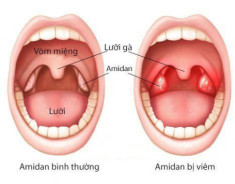 Viêm amidan cấp ở trẻ: Nguyên nhân, triệu chứng và cách điều trị