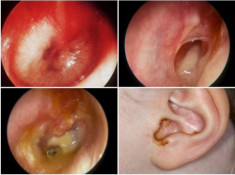 Viêm tai giữa ở trẻ em: Dấu hiệu và cách điều trị bệnh cấp tính cho bé