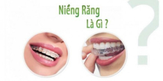 Niềng răng thẩm mỹ và những điều bạn nên cần biết