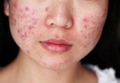 Mụn trứng cá, mụn đầu đen gì cũng hết với 3 công thức chưa đến 10 ngàn đồng dưới đây