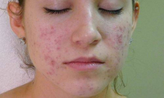 Ngày nào cũng skincare mụn vẫn mọc như nấm, hãy áp dụng ngay 2 công thức dưới đây