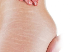 Rạn da đến mấy cũng mờ đi với công thức thần kỳ từ viên Vitamin E và nha đam