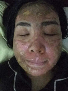 Sốc trước gương mặt của cô gái trẻ trước 15 ngày cưới khi tin vào mỹ phẩm “xịn”